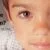 Lazy Eye Problem Here’s What to Do,